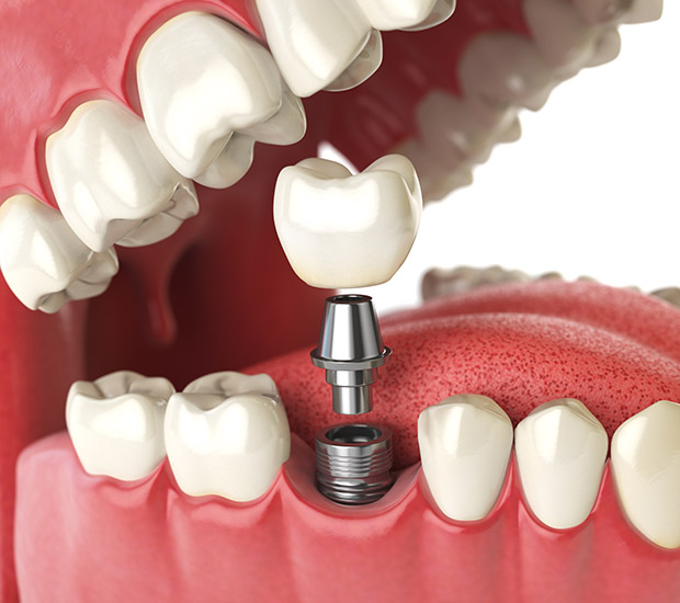 Brentwood Will I Need a Bone Graft for Dental Implants