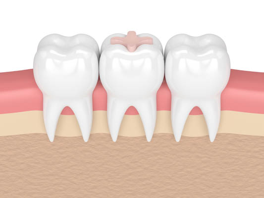 Tips For Extending The Longevity Of Dental Fillings