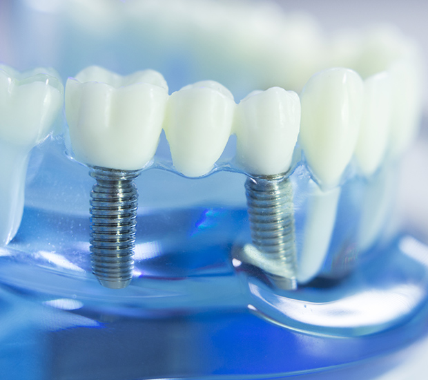 Brentwood Dental Implants